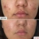 Erborian cuidado de acne de centella, 30 ml.